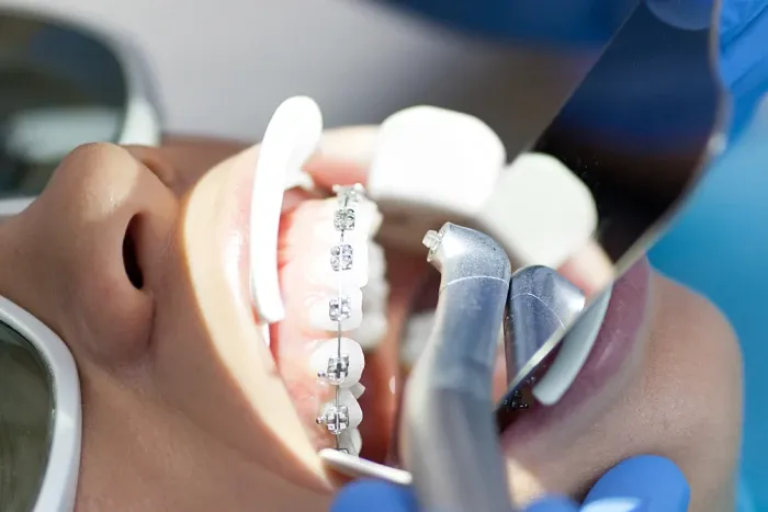 How to Prevent Teeth from Deteriorating Again After Orthodontics.webp