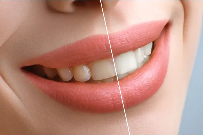What are the Professional Teeth Whitening Methods.webp