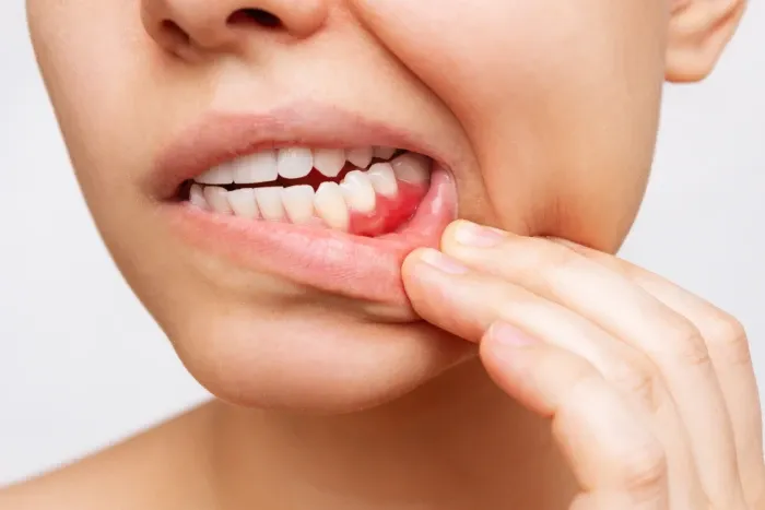 gum recession.webp